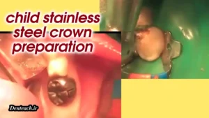 child stainless steel crown preparation