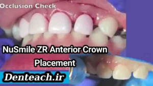 Practical Demonstration: NuSmile ZR Anterior Crown Placement
