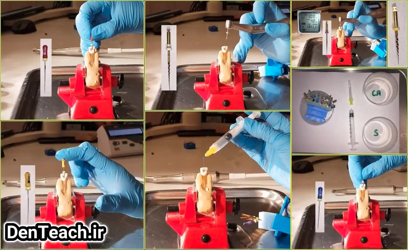 Endodontics treatment of the single rooted tooth