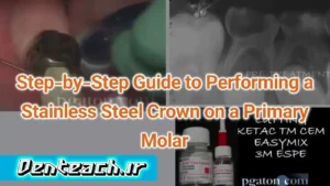 Step-by-Step Guide to Performing a Stainless Steel Crown on a Primary Molar