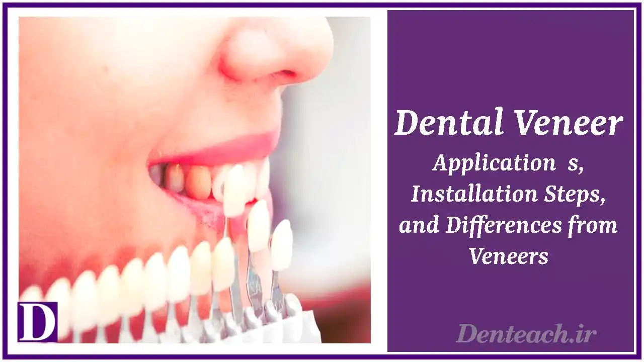 Dental Veneer